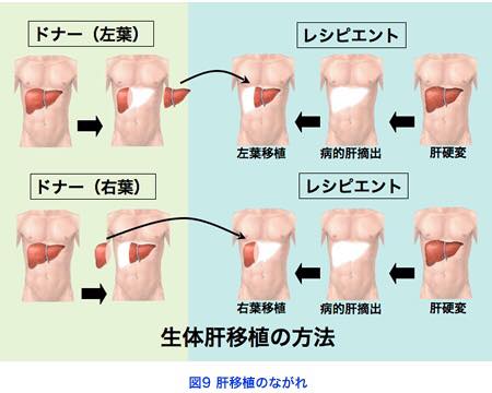 生体肝移植の方法